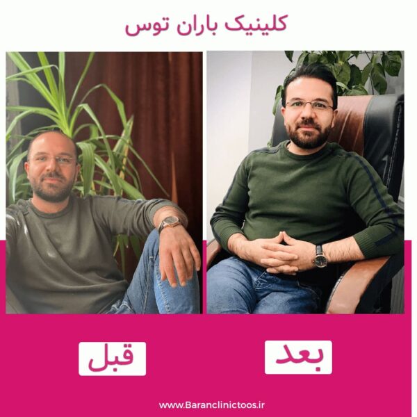 قبل و بعد کاشت مو کلینیک باران توس