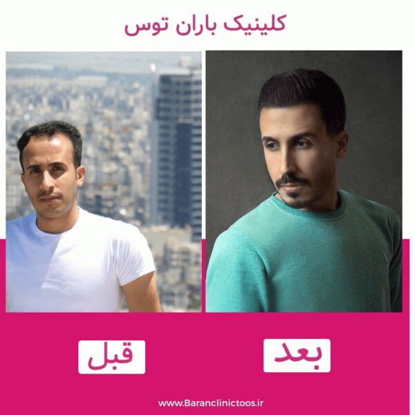 قبل و بعد کاشت مو کلینیک باران توس